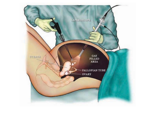 Laparoscopic Sterilization