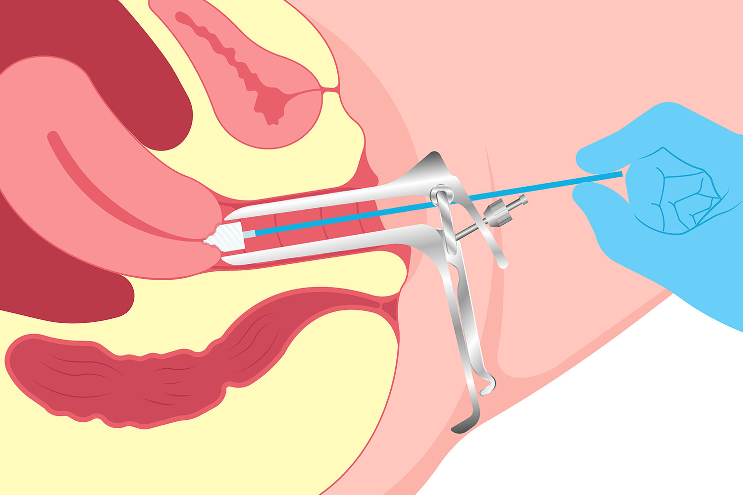 Papsmear & LBC Screening