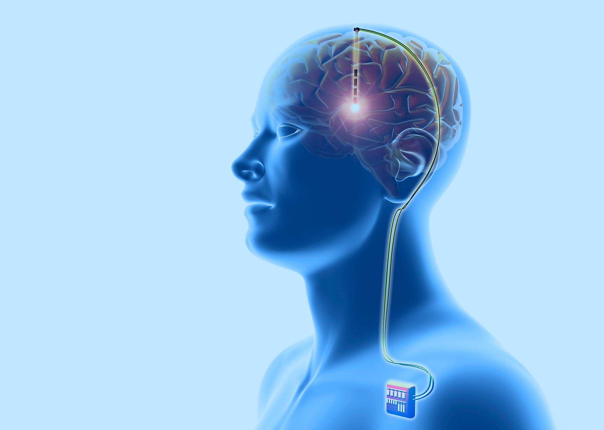 Dr. Bharath Kumar - Deep Brain Stimulation Specialist
