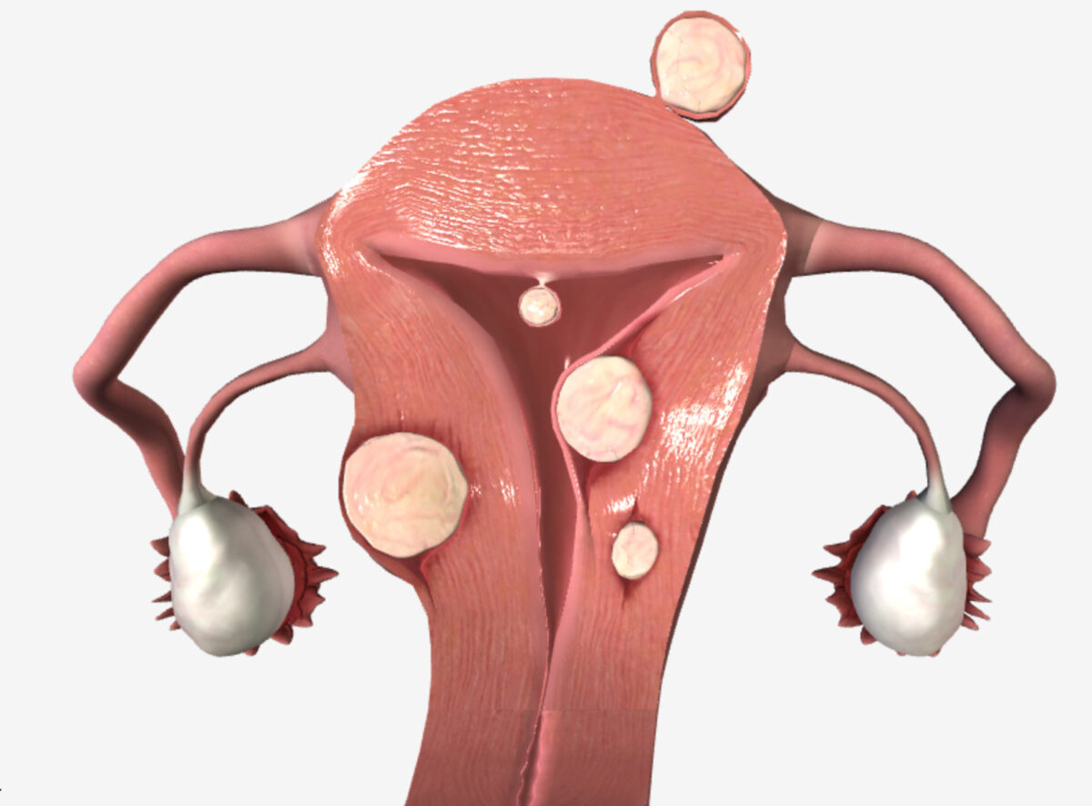 Fibroid Uterus Treatment
