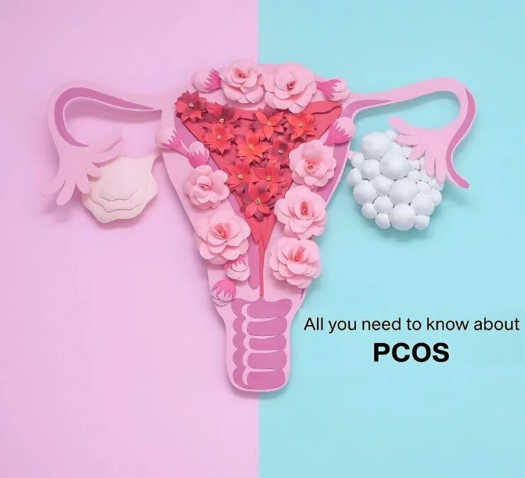 PCOS Treatment